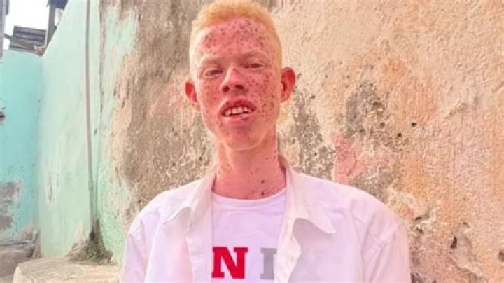 Are albinos considered disabled?