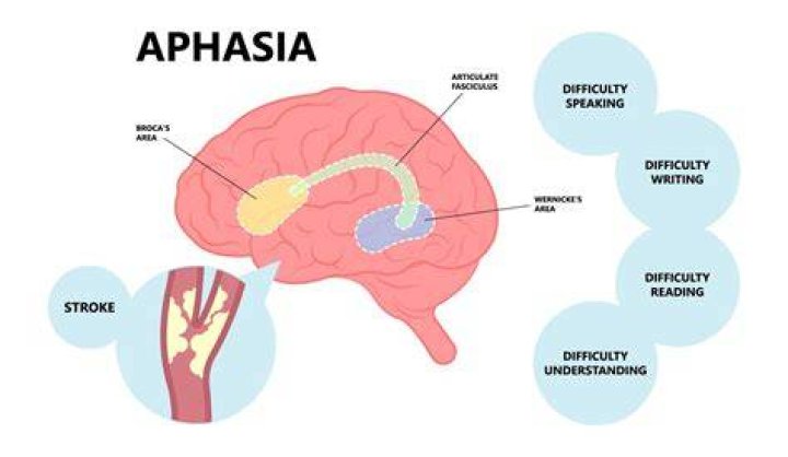 Can alcoholism cause aphasia?