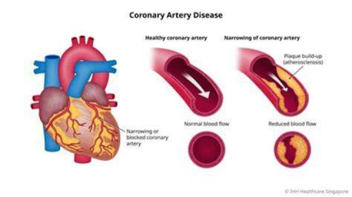 Can blocked arteries cause fatigue?