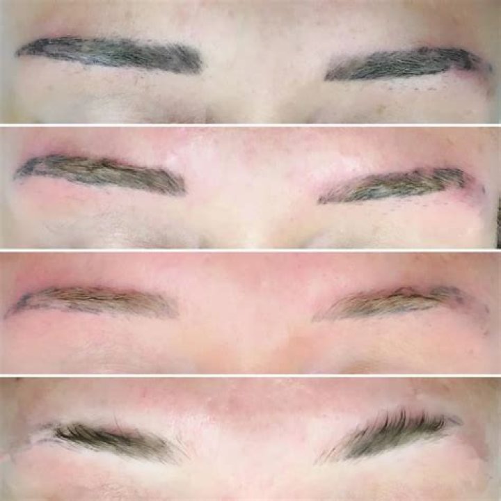 Can eyebrow tattoo be removed?