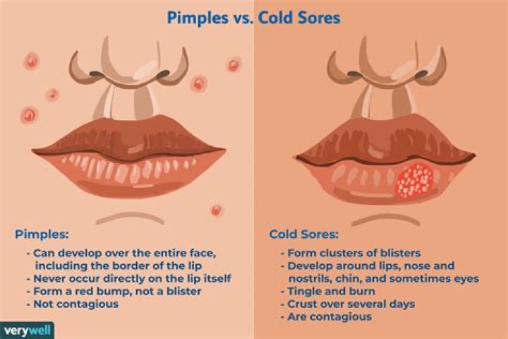 Can I get a pimple on my lip?