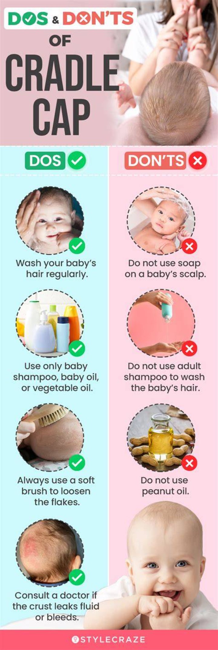 Can I just leave cradle cap alone?