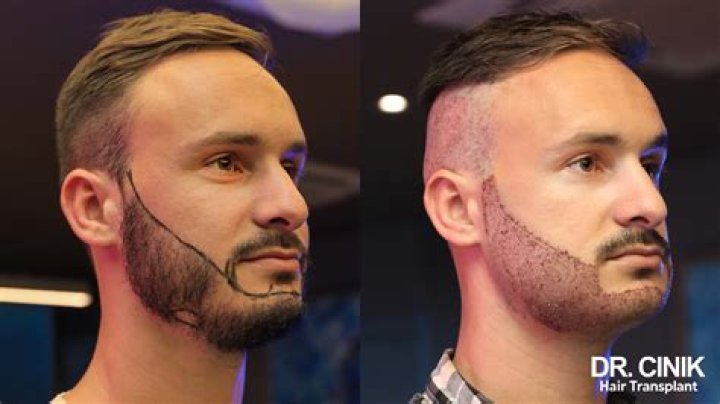 Can I use beard hair for hair transplant?