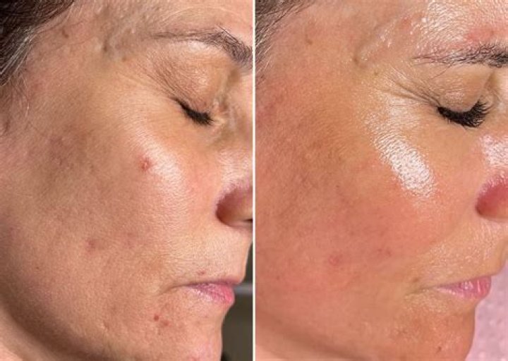 Can microneedling tighten skin?