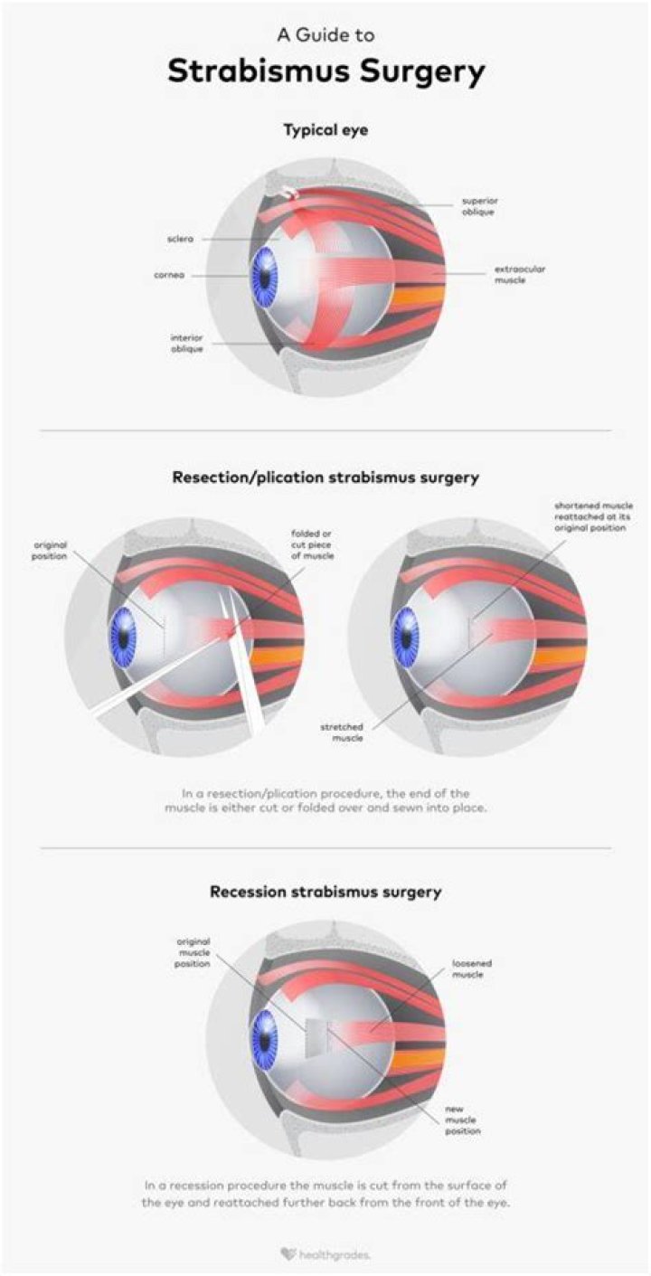 Can you drink alcohol after strabismus surgery?