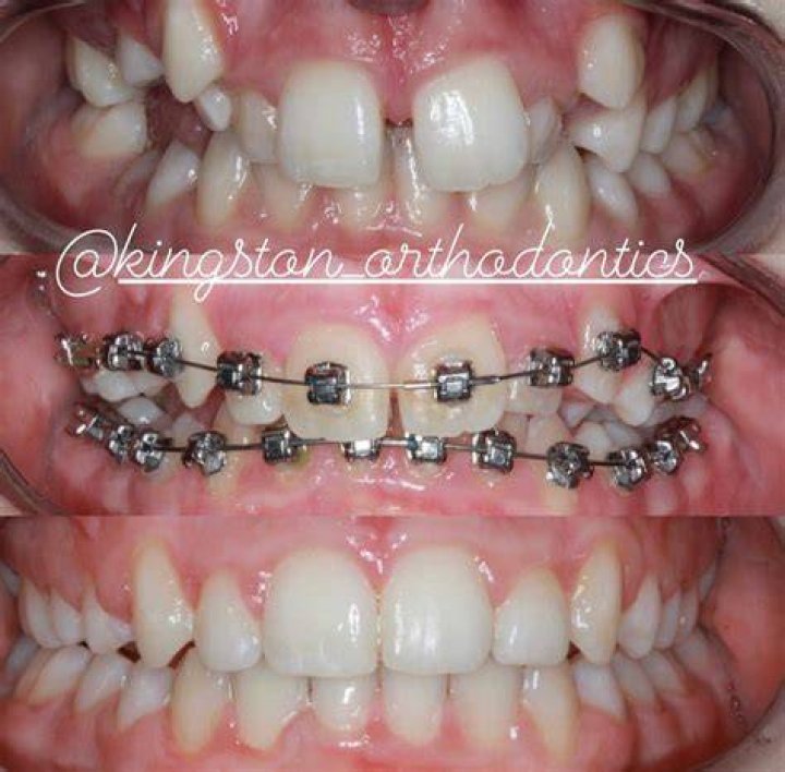 Can you get braces at 55?