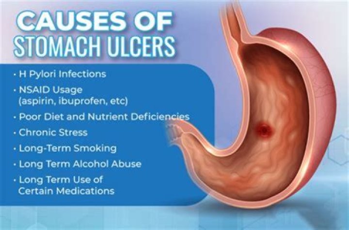 Can you get stomach ulcers from not eating?