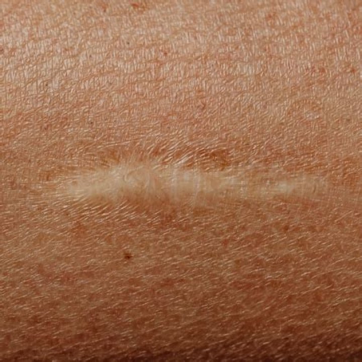 Do all scars turn white?