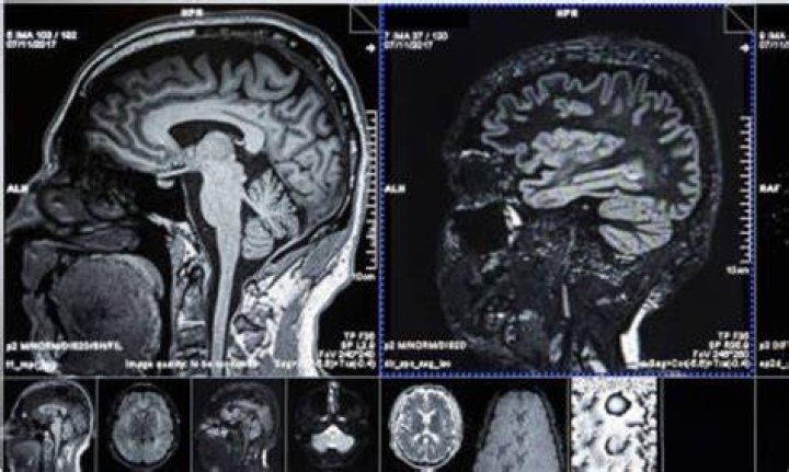 Do all strokes show up on a CT scan?