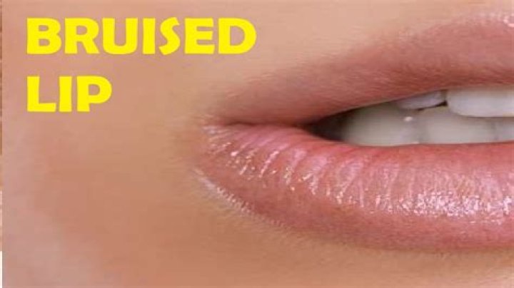 Do you bruise from a lip flip?