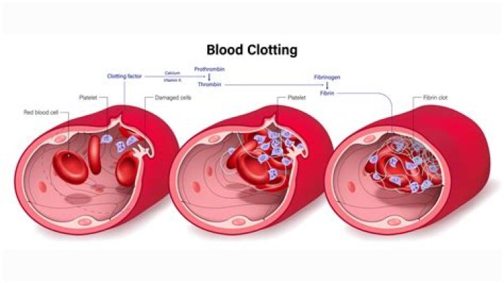 Does bed rest cause blood clots?
