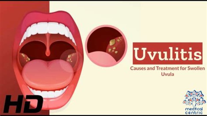 Does Covid 19 cause uvulitis?