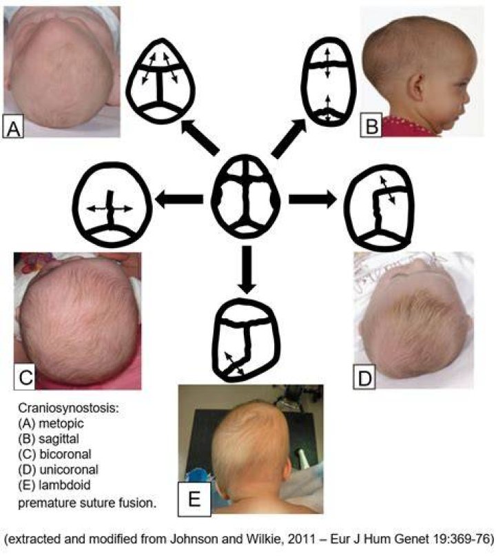 Does craniosynostosis get worse with age?