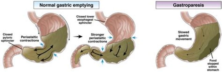 Does gastroparesis get worse over time?