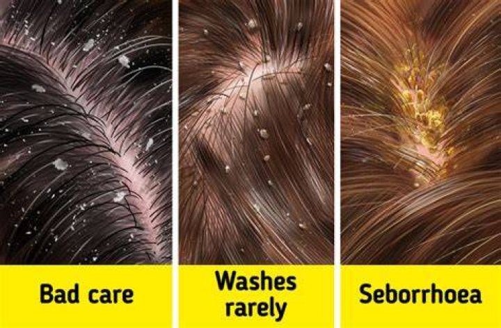 Does hard water cause dandruff?