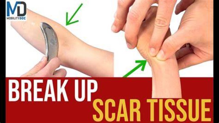 Does heat help break up scar tissue?
