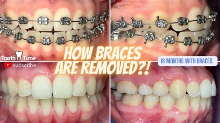 Does it hurt to have braces removed?