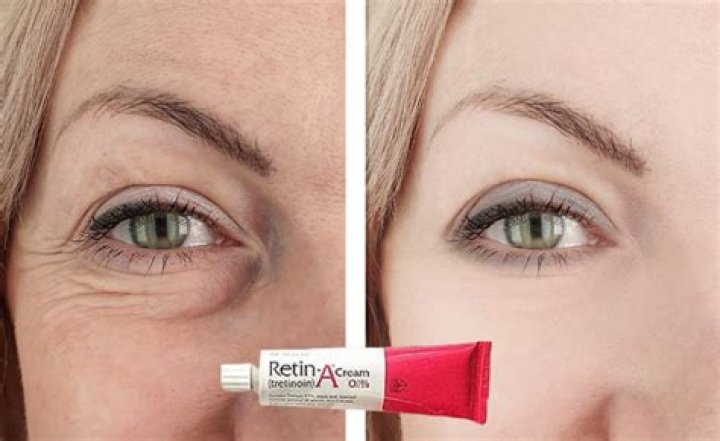 Does Retin-A restore collagen?