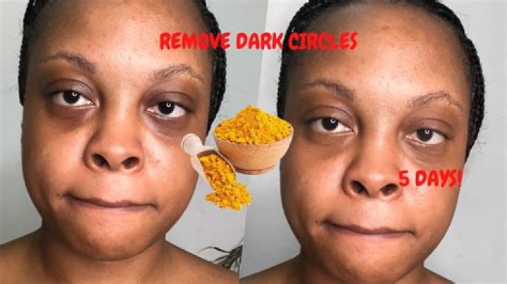 Does turmeric reduce dark circles?