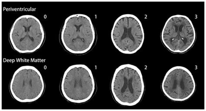 Does white matter increase with age?