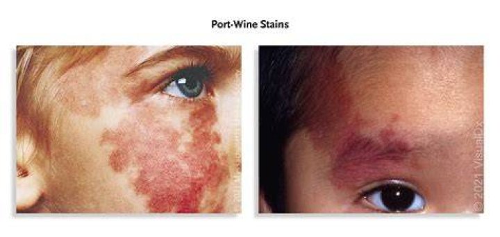 How can you tell the difference between a port wine stain and a salmon patch?