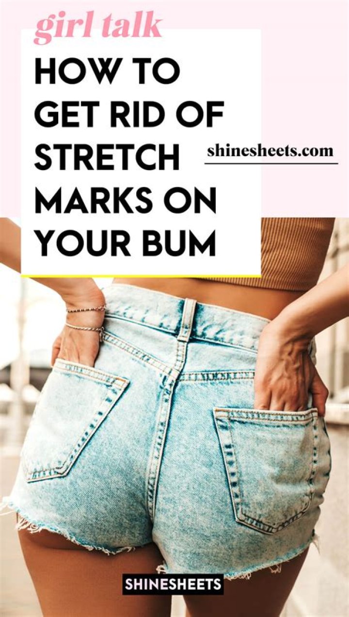 How do I get rid of stretch marks on my butt and thighs?