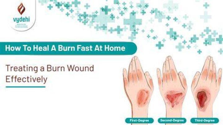 How do I heal a burn quickly?
