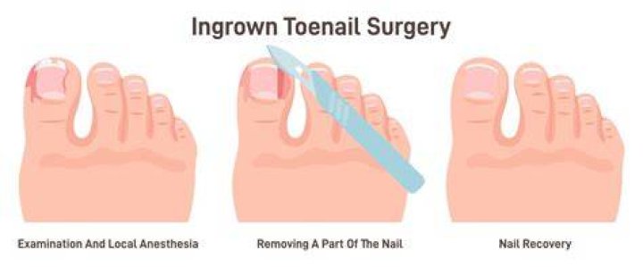 How do you cut an ingrown toenail painlessly?