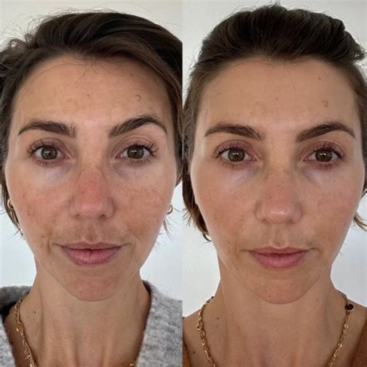 How does face look after microneedling?