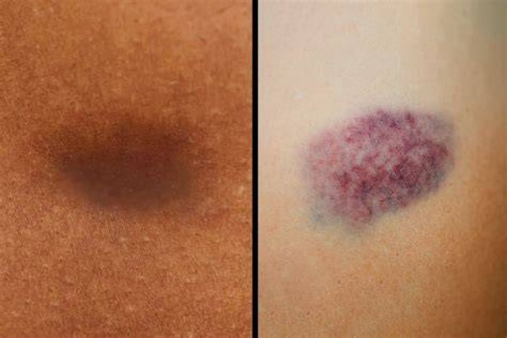 How long does it take for a yellow bruise to fade?