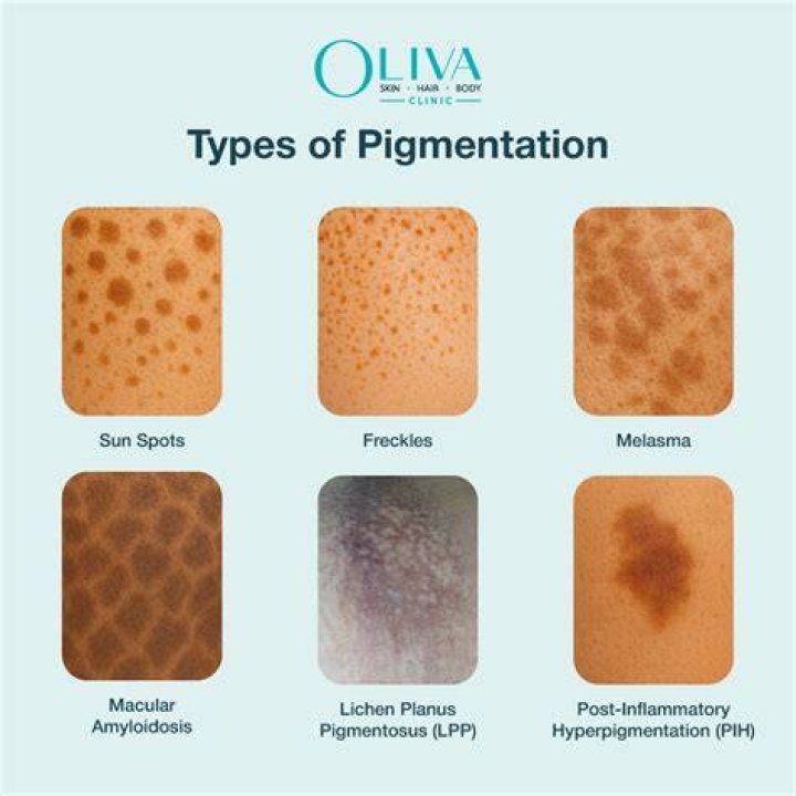 How long does it take for pigmentation to fade?