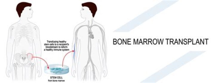 How long does it take to get a bone marrow transplant?