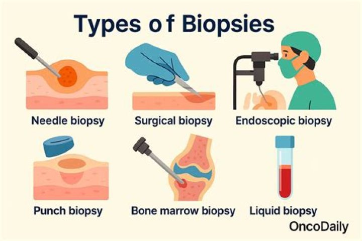 How many biopsies come back positive?