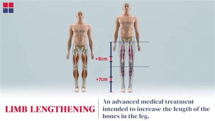 How many inches can you gain from limb lengthening?