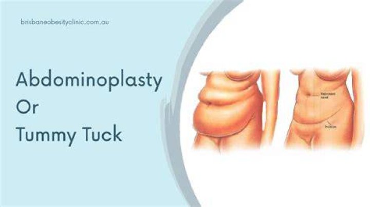 How many lbs Do you lose after a tummy tuck?