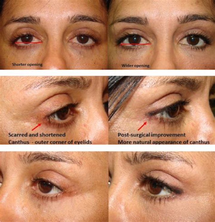 How much does Canthoplasty cost?