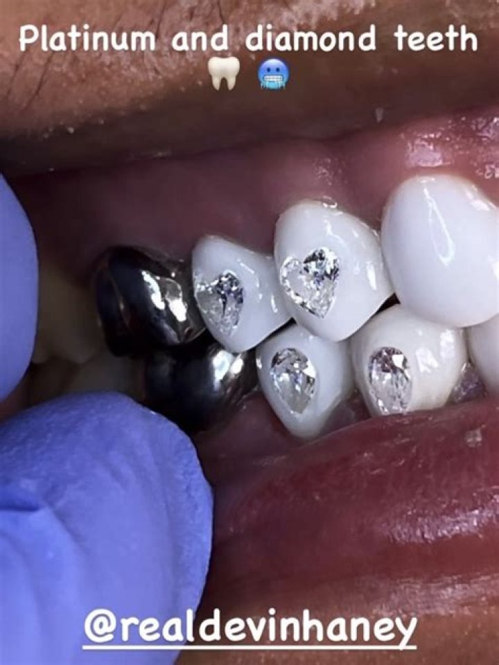 How much is platinum teeth?