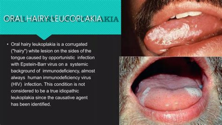 Is hairy leukoplakia benign?