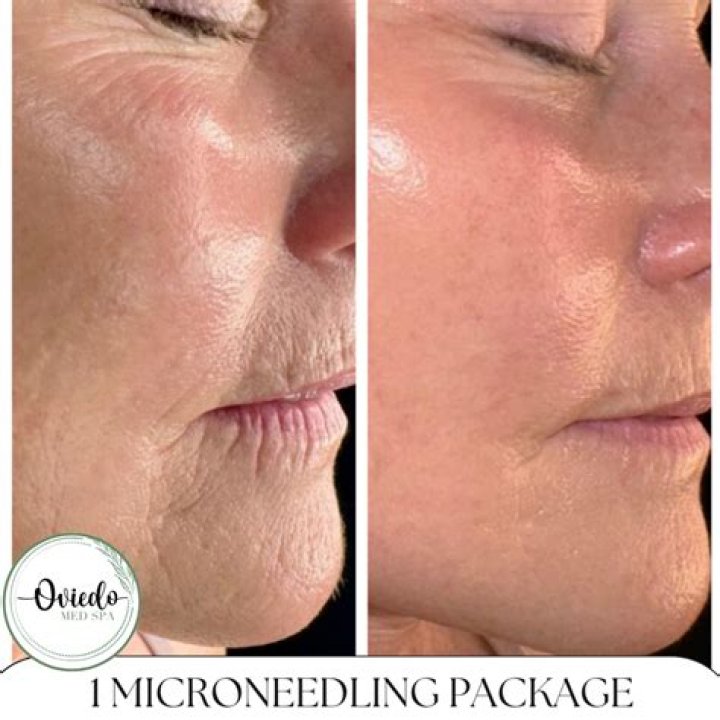 Is microneedling worth the cost?