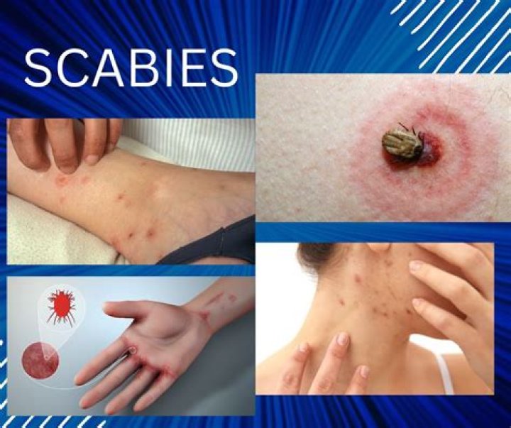 Is Scabies a fungus or parasite?