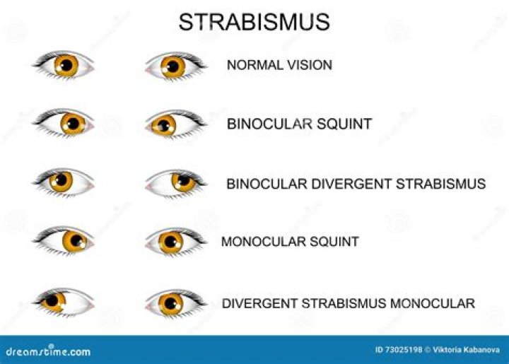 Is strabismus neurological?