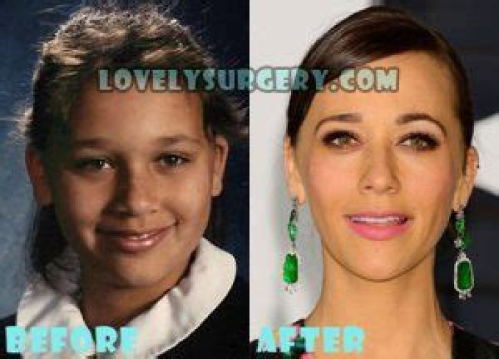 Rashida Jones Plastic Surgery Before and After