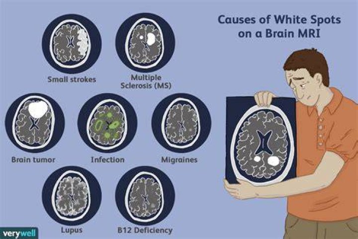 What are bright white spots on MRI?
