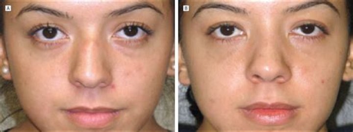 What are spreader grafts made of?