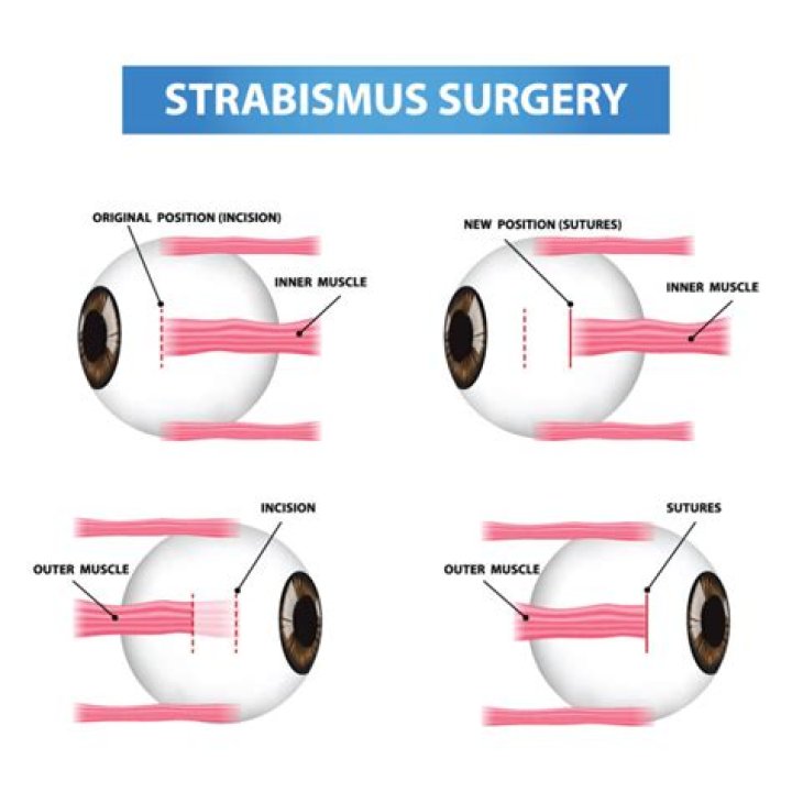 What can go wrong with strabismus surgery?