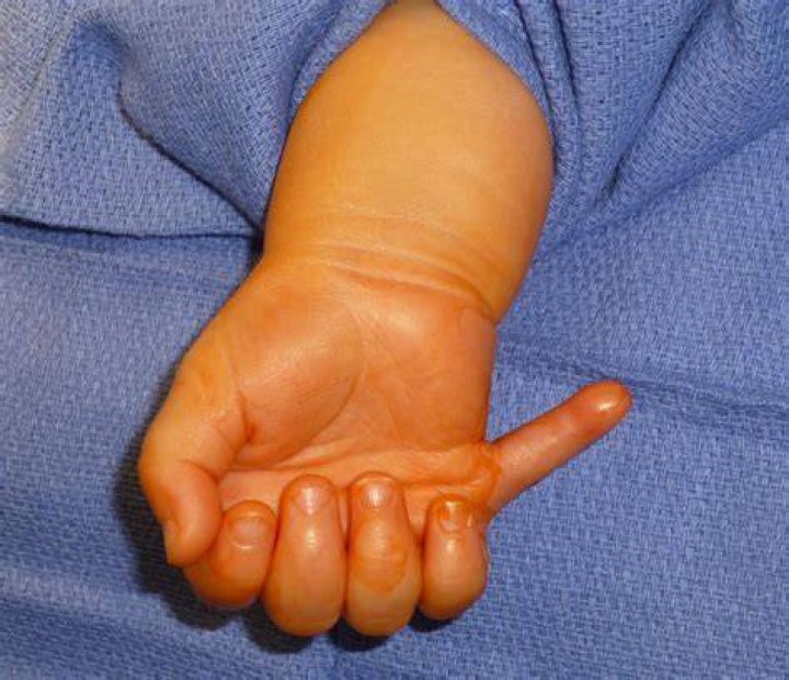 What causes missing fingers at birth?