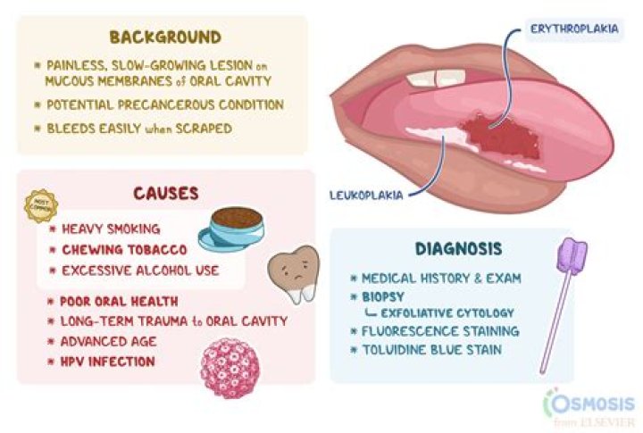 What causes oral mucosa?