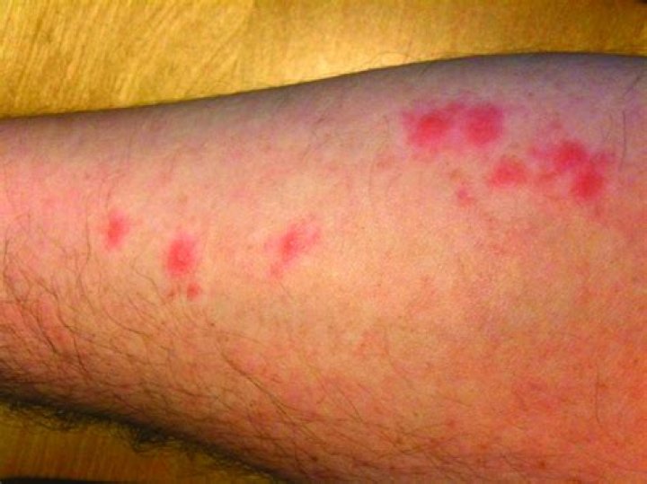 What does a bed bug bite look like on a human?