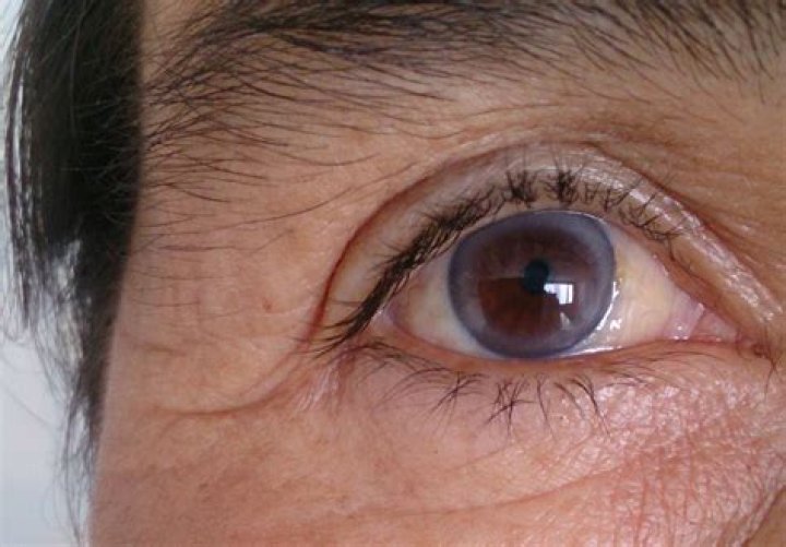 What does the circle around the eye mean?