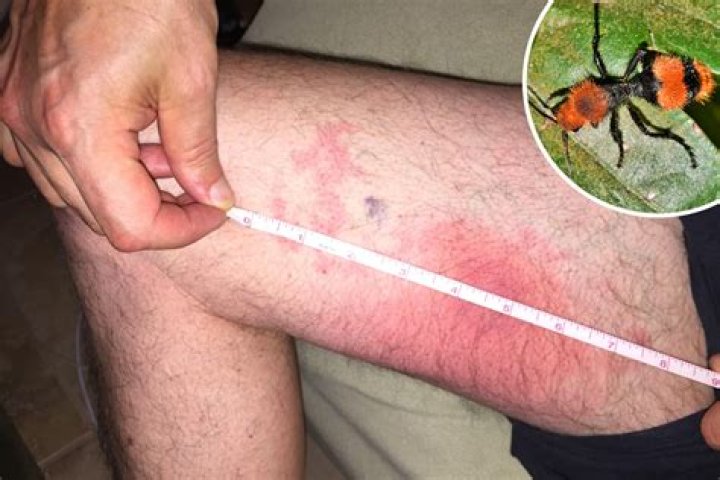 What happens if a cow bites you?